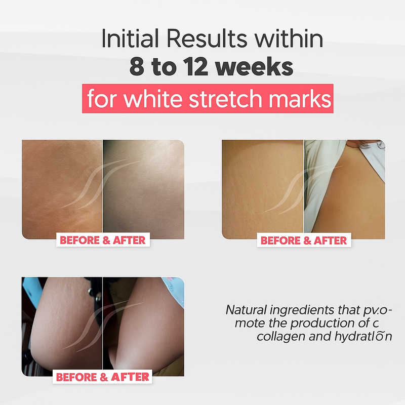 Cicatrissim White - Specific cream for white stretch marks